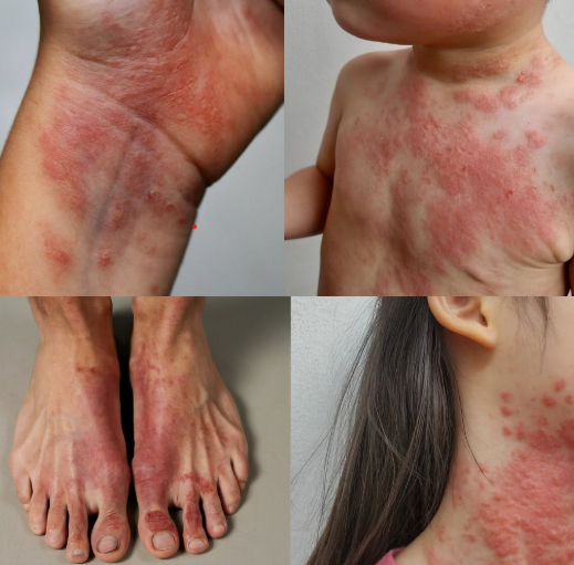 Eczema