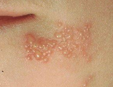 Herpes