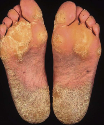Keratoderma