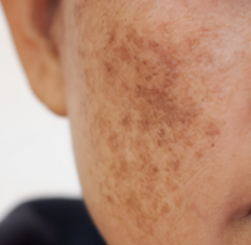Melasma