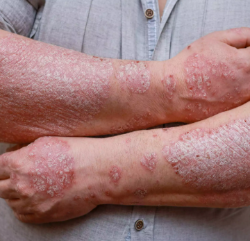 Psoriasis