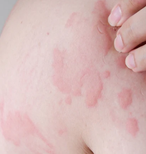 Urticaria / Pruritus