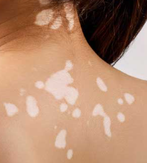 Vitiligo
